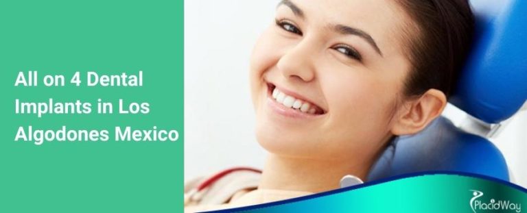 Best All On Dental Implants In Los Algodones Mexico