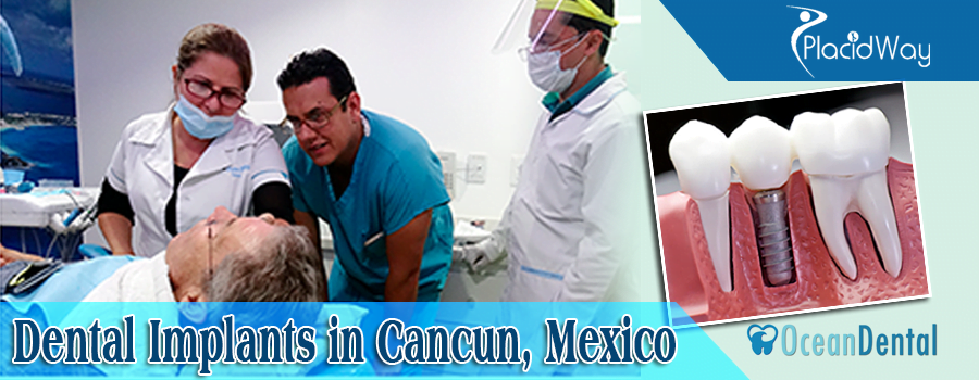 Dental-Implants-in-Cancun-Mexico