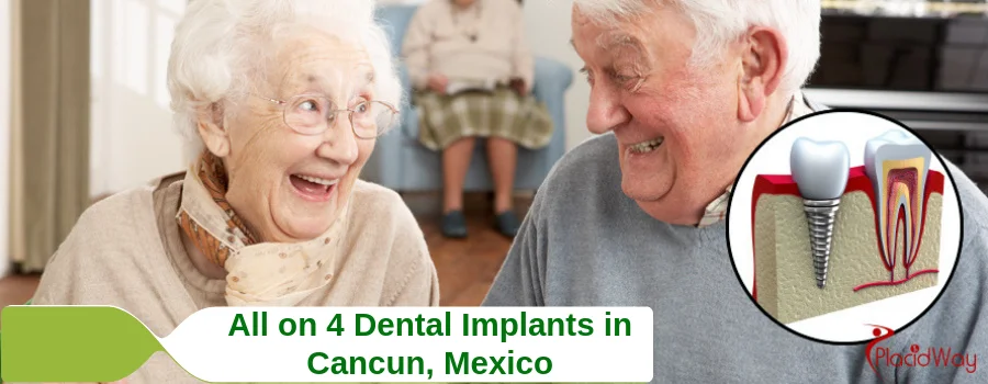 All on 4 Dental Implants in Cancun