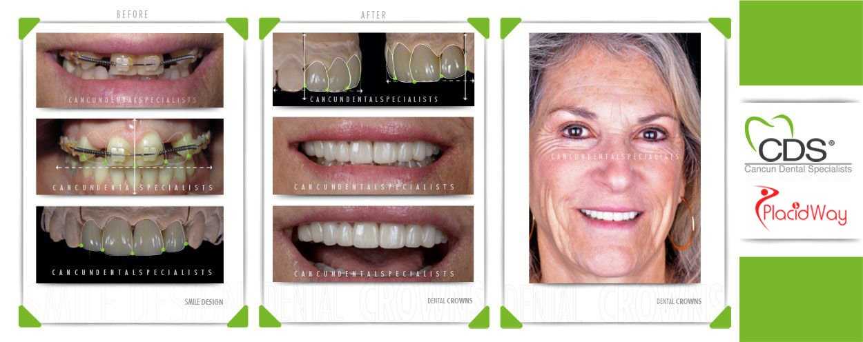 dental crowns before and after in cancun mexico