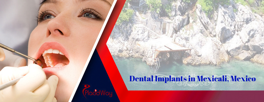 Dental Implant in Mexicali