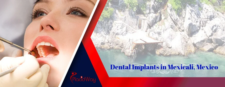 Dental Implant in Mexicali
