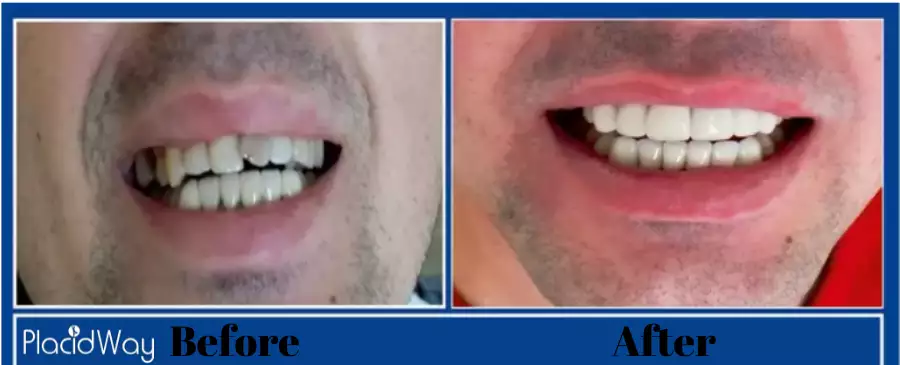 Dental Crown Before and After in Nuevo Progreso, Mexico 