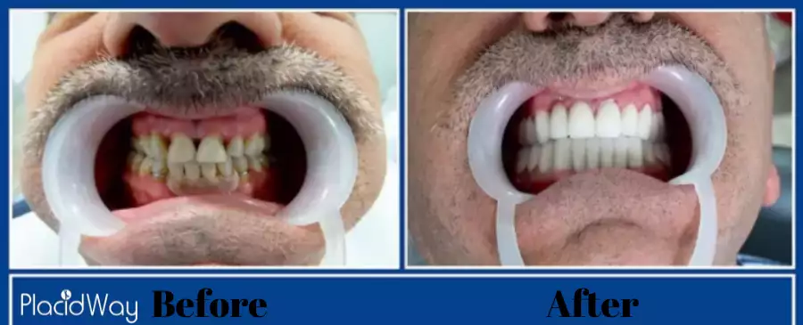 Dental Veneers testimonial mexico