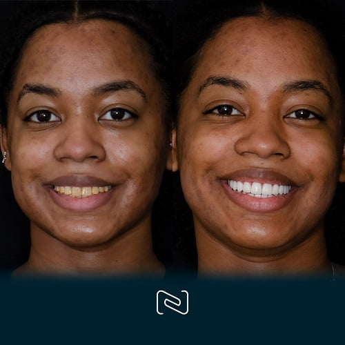 Before and After Cosmetic Dentistry in Cancun, Mexico by NEO Dental