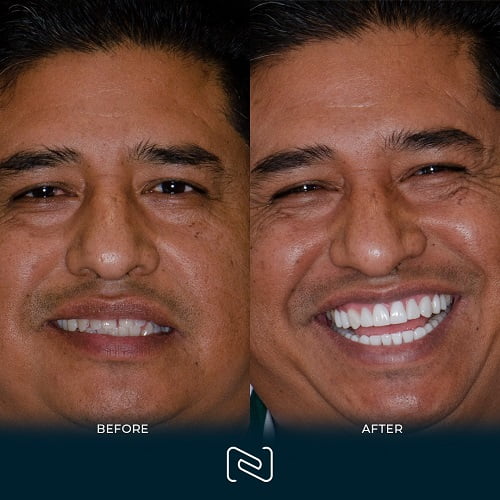 Before and After Teeth Veneers in Cancun, Mexico by NEO Dental
