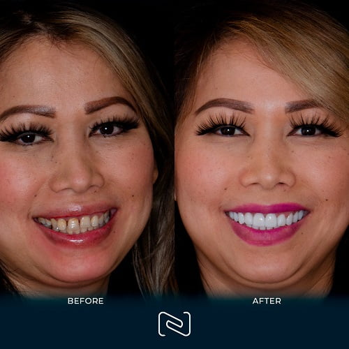 Before and After Smile Makeover in Cancun, Mexico by NEO Dental
