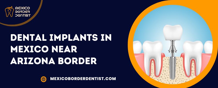 Dental Implants in Mexico Near Arizona Border