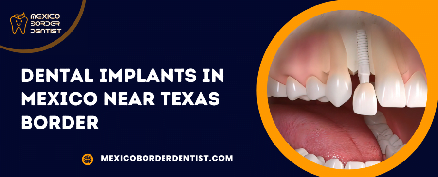 Dental Implants in Mexico Near Texas Border