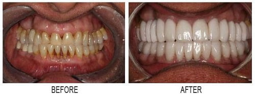 Before and After Teeth Whitening in Puerto Vallarta, Mexico