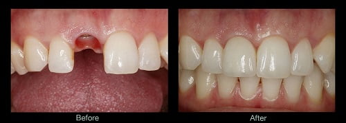 Before and After Denture in Puerto Vallarta, Mexico