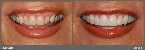 Before and After Cosmetic Dentistry in Puerto Vallarta, Mexico