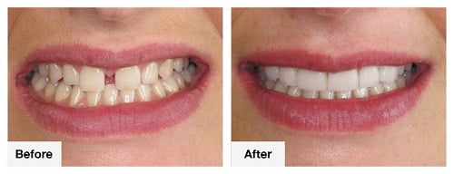 Before and After Dental Braces in Puerto Vallarta, Mexico
