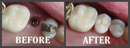Before and After Dental Implant in Puerto Vallarta, Mexico