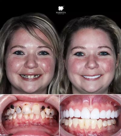 Before and After Dental Treatment in Los Algodones Mexico