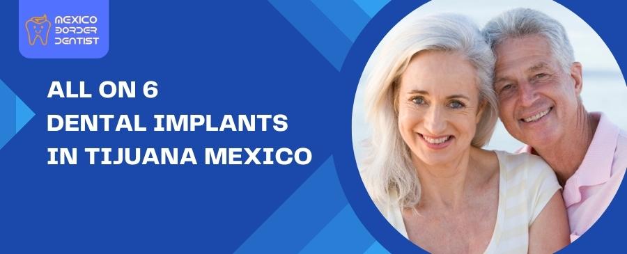 All on 6 Dental Implants in Tijuana