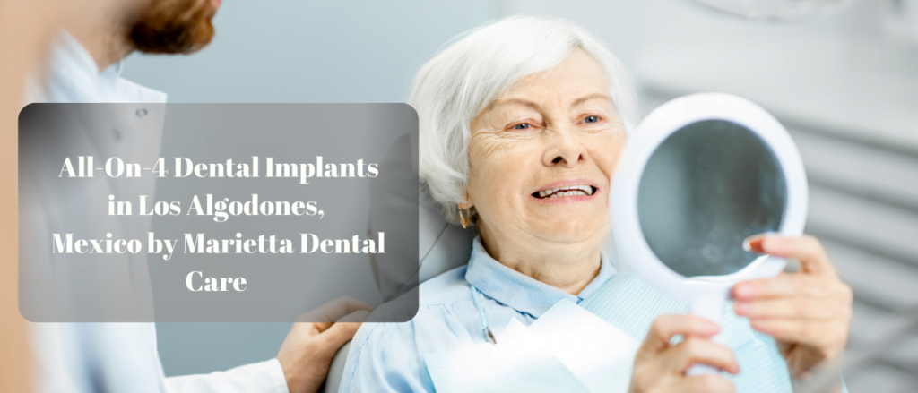 All-On-4 Dental Implants in Los Algodones, Mexico by Marietta Dental Care