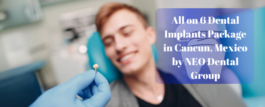 All-on-6 Dental Implants in Cancun, Mexico