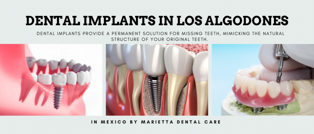 Dental Implants in Los Algodones