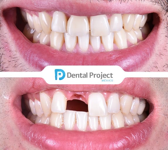 Dental Project Mexico