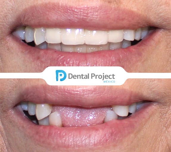 Dental Project Mexico