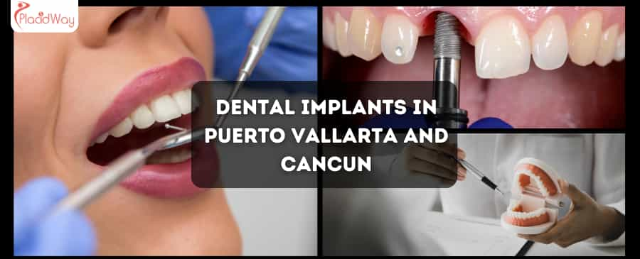 Affordable Dental Implants in Puerto Vallarta & Cancun