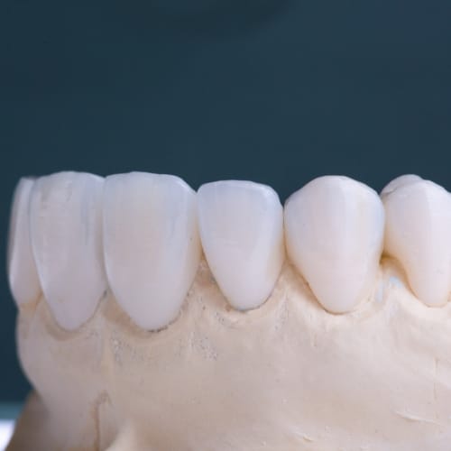 Dental Crowns in Mexico