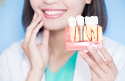 Dental Implants in Mexico