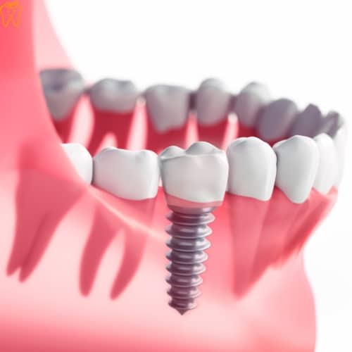 Dental Implants in Mexico