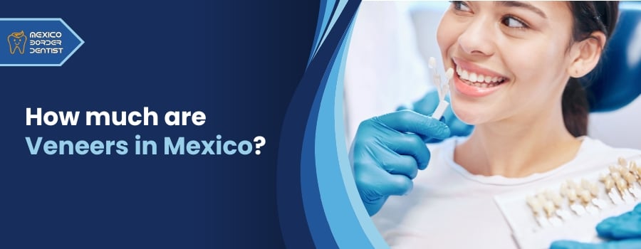 How much are Veneers in Mexico?