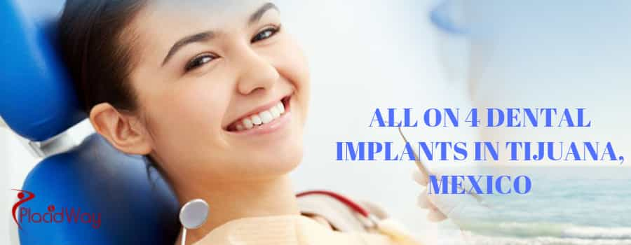 All on 4 Dental Implants in Tijuana