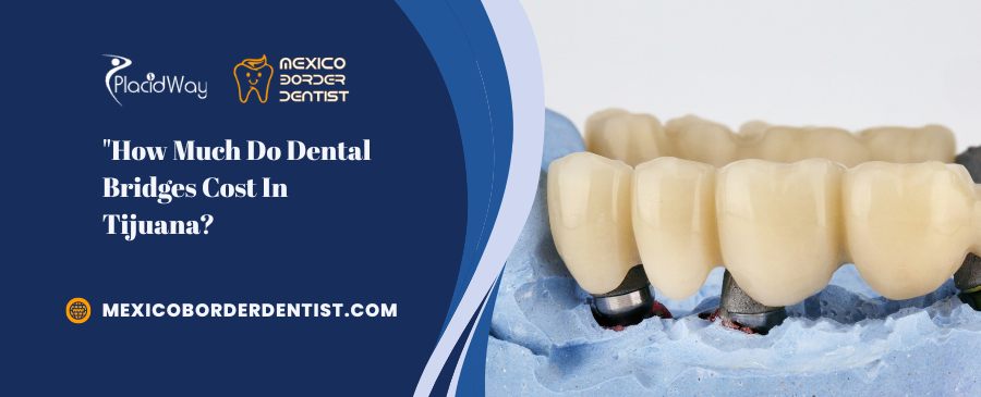 How Much Do Dental Bridges Cost In Tijuana 1