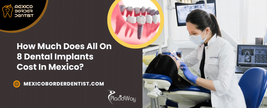How Much Does All On 8 Dental Implants Cost In