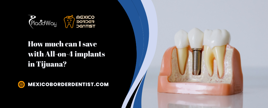 What Is The All on 4 Implant Procedure In Tijuana 1 What Is The All on 4 Implant Procedure In Tijuana 1