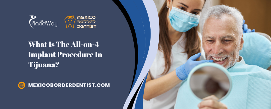 What Is The All on 4 Implant Procedure In Tijuana