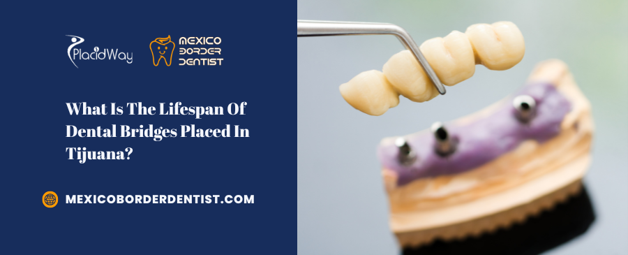 What Is The Lifespan Of Dental Bridges Placed In Tijuana