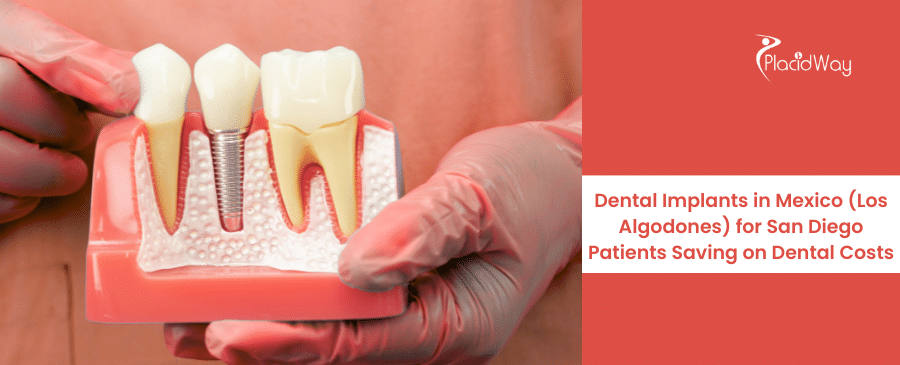 Dental Implants in Mexico (Los Algodones) for San Diego Patients Saving on Dental Costs