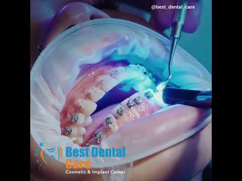 Advanced Orthodontic Treatments and Affordable Dental Care in Los Alogdones, Mexico – Your Options