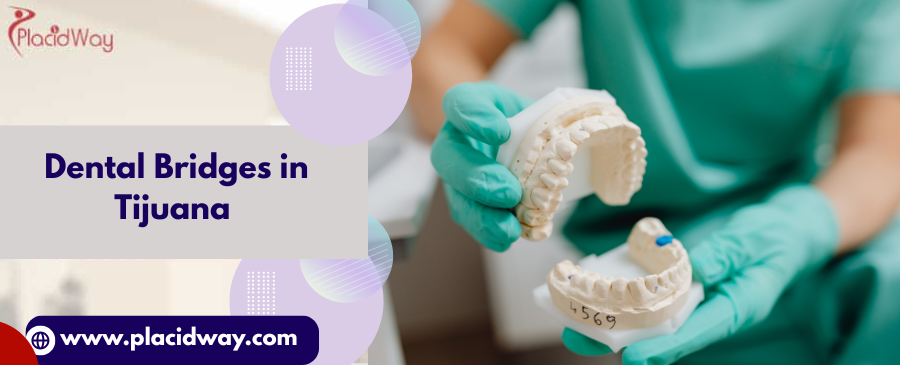 What is the Lifespan of Dental Bridges Placed in Tijuana?