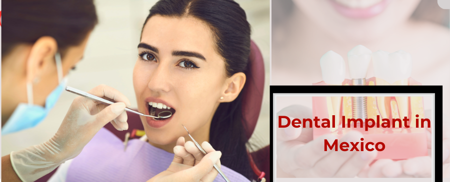 How Many Visits Do You Need for Dental Implants in Mexico for a New Smile?