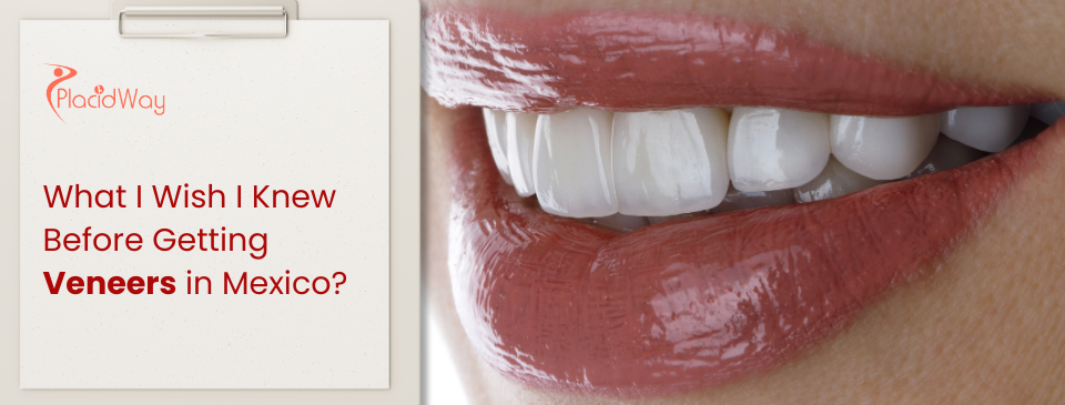 What I Wish I Knew Before Getting Veneers in Mexico?