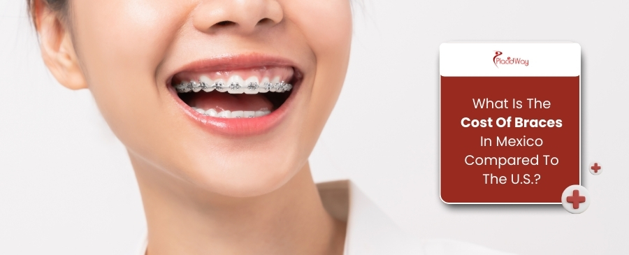 What Is The Cost Of Braces In Mexico Compared To The U.S.?