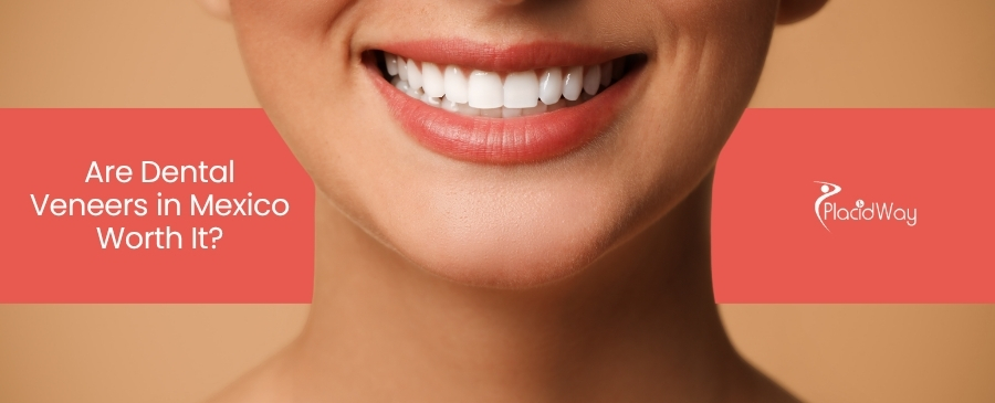 Are Dental Veneers in Mexico Worth It for Your Smile Transformation?