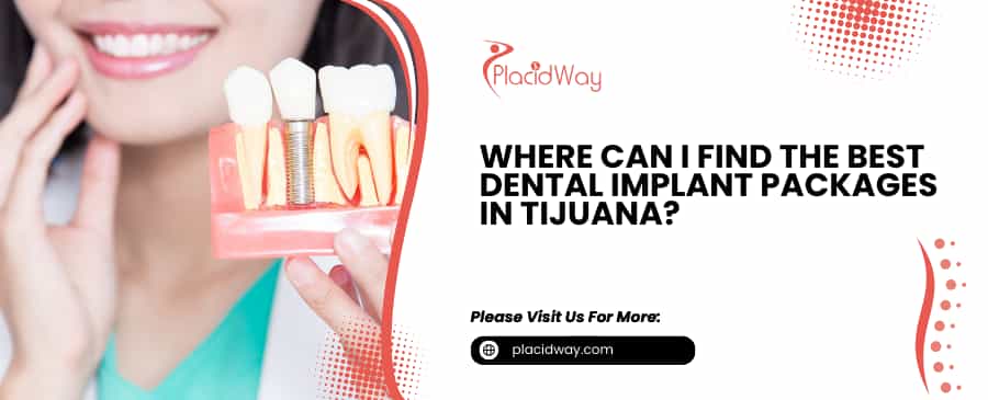 Where Can I Find the Best Dental Implant Packages in Tijuana?
