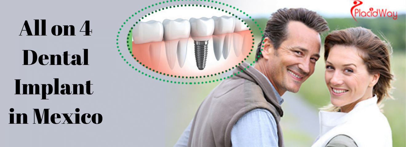 all on 4 dental implant in mexico