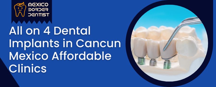 All on 4 Dental Implants in Cancun Mexico