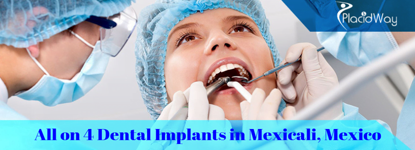 All on 4 Dental Implants in Mexicali