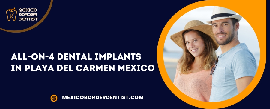 All-on-4 Dental Implants in Playa Del Carmen Mexico