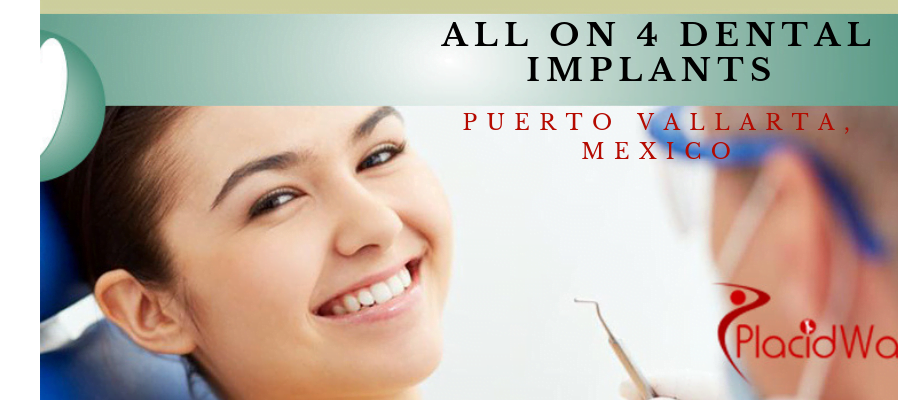 All-on-4 Dental Implants in Puerto Vallarta Mexico