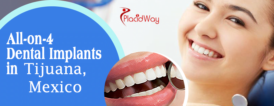 All on 4 Dental Implants in Tijuana, Mexico